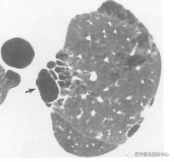 影像PPT - 肺含气囊腔分类、定义及CT诊断思维-7 影像PPT - 肺含气囊腔分类、定义及CT诊断思维-7