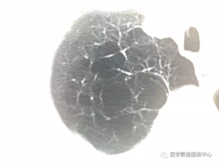 影像PPT - 肺含气囊腔分类、定义及CT诊断思维-9 影像PPT - 肺含气囊腔分类、定义及CT诊断思维-9
