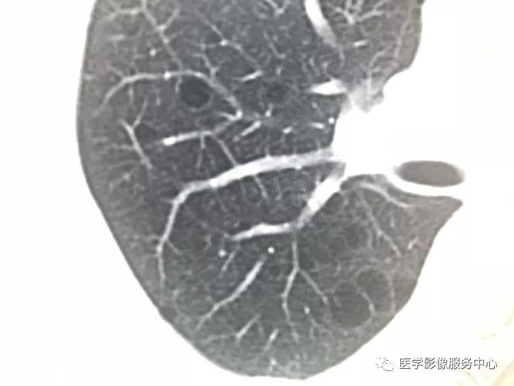 影像PPT - 肺含气囊腔分类、定义及CT诊断思维-5 影像PPT - 肺含气囊腔分类、定义及CT诊断思维-5