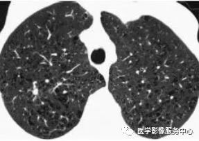 影像PPT - 肺含气囊腔分类、定义及CT诊断思维-16 影像PPT - 肺含气囊腔分类、定义及CT诊断思维-16