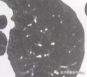 影像PPT - 肺含气囊腔分类、定义及CT诊断思维-18 影像PPT - 肺含气囊腔分类、定义及CT诊断思维-18