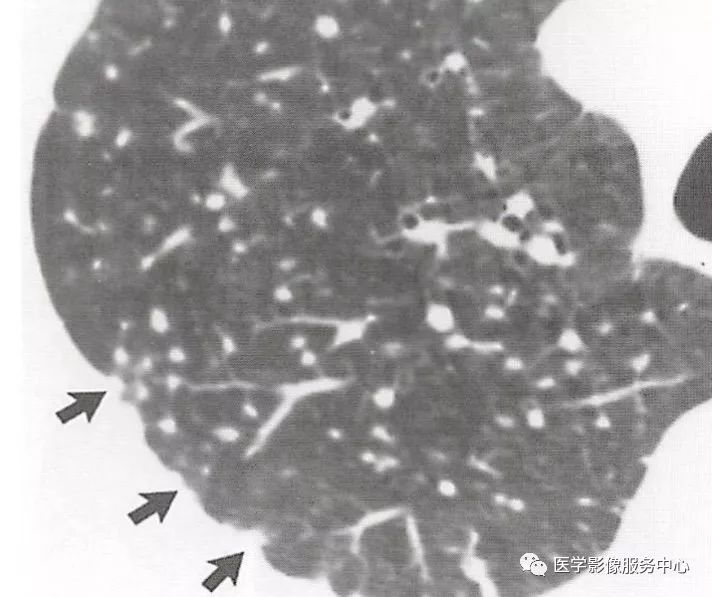 影像PPT - 肺多发小结节病变的影像诊断思维-6 影像PPT - 肺多发小结节病变的影像诊断思维-6