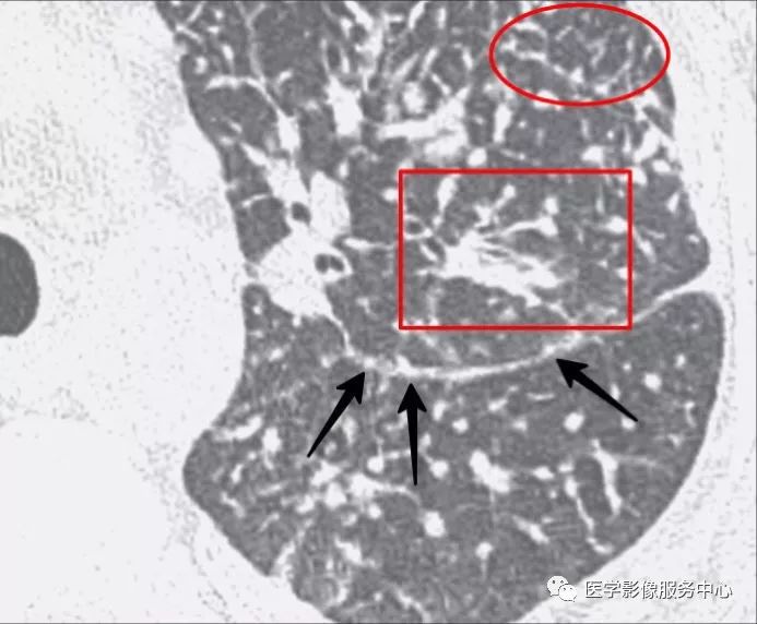 影像PPT - 肺多发小结节病变的影像诊断思维-7 影像PPT - 肺多发小结节病变的影像诊断思维-7