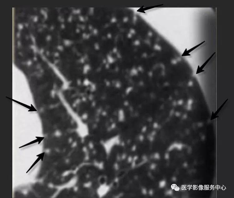 影像PPT - 肺多发小结节病变的影像诊断思维-8 影像PPT - 肺多发小结节病变的影像诊断思维-8