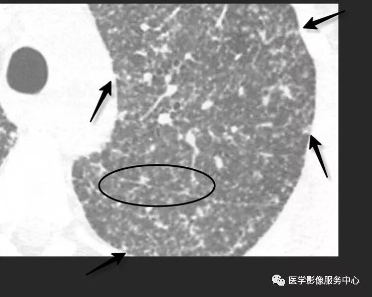 影像PPT - 肺多发小结节病变的影像诊断思维-9 影像PPT - 肺多发小结节病变的影像诊断思维-9