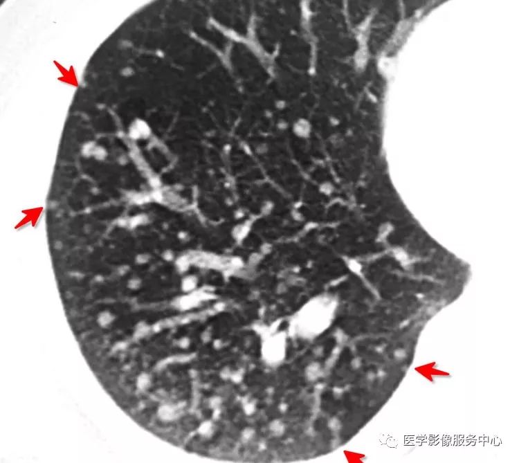 影像PPT - 肺多发小结节病变的影像诊断思维-10 影像PPT - 肺多发小结节病变的影像诊断思维-10