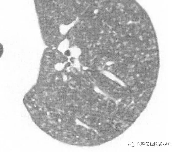 影像PPT - 肺多发小结节病变的影像诊断思维-12 影像PPT - 肺多发小结节病变的影像诊断思维-12