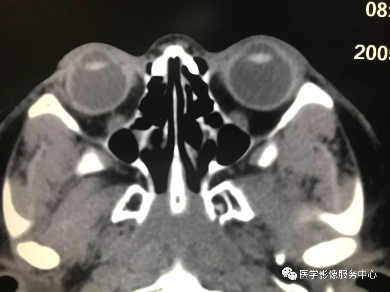影像PPT - 【病例】眼部这种病变,原来是个“迷”-1 影像PPT - 【病例】眼部这种病变,原来是个“迷”-1