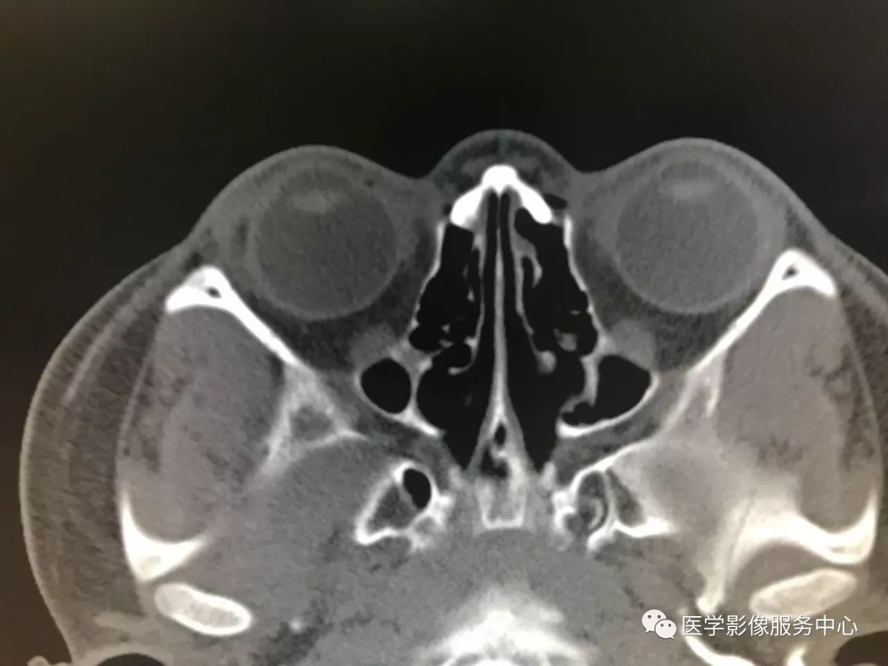影像PPT - 【病例】眼部这种病变,原来是个“迷”-10 影像PPT - 【病例】眼部这种病变,原来是个“迷”-10
