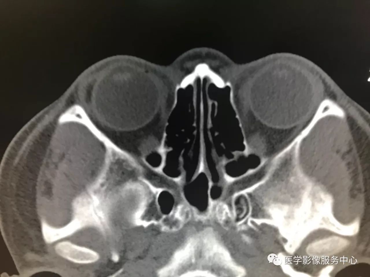 影像PPT - 【病例】眼部这种病变,原来是个“迷”-11 影像PPT - 【病例】眼部这种病变,原来是个“迷”-11