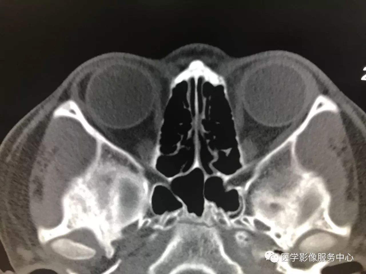 影像PPT - 【病例】眼部这种病变,原来是个“迷”-12 影像PPT - 【病例】眼部这种病变,原来是个“迷”-12