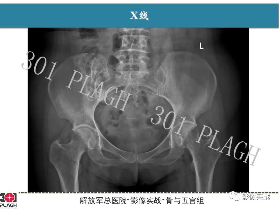影像PPT - 【病例】骨纤维结构不良1例X线MR影像-3