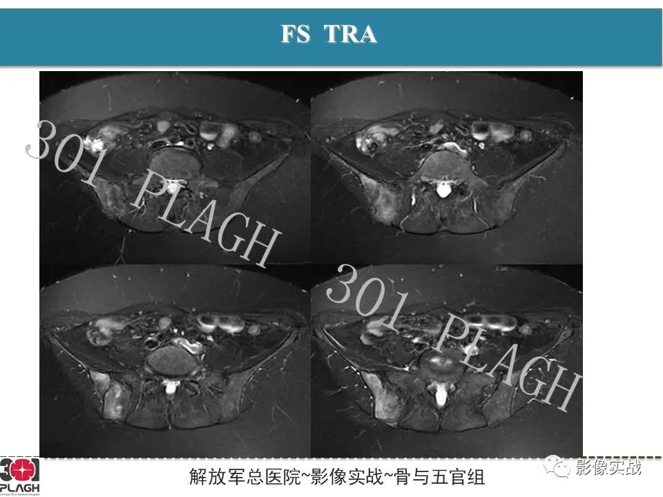 影像PPT - 【病例】骨纤维结构不良1例X线MR影像-5