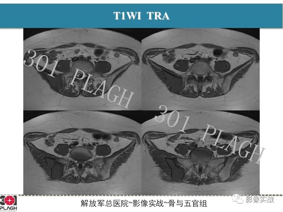 影像PPT - 【病例】骨纤维结构不良1例X线MR影像-4