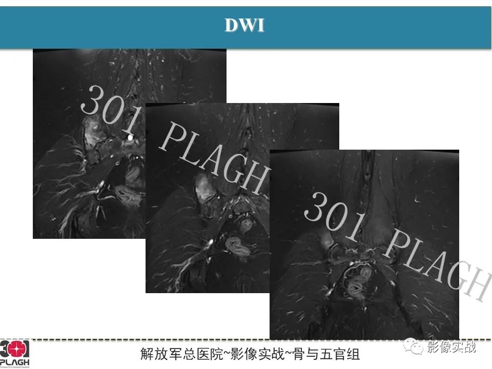 影像PPT - 【病例】骨纤维结构不良1例X线MR影像-6