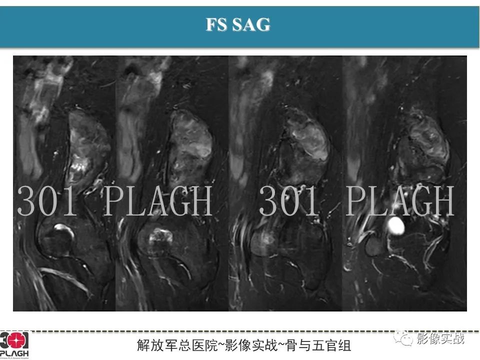 影像PPT - 【病例】骨纤维结构不良1例X线MR影像-7