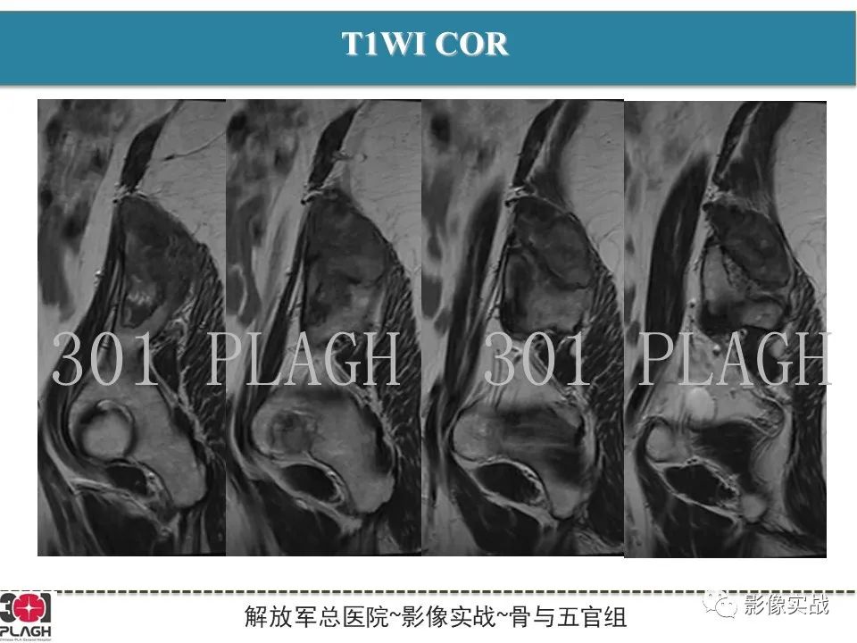 影像PPT - 【病例】骨纤维结构不良1例X线MR影像-8