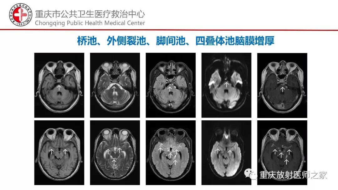影像PPT - 【PPT】颅内结核分型及其影像学表现-13