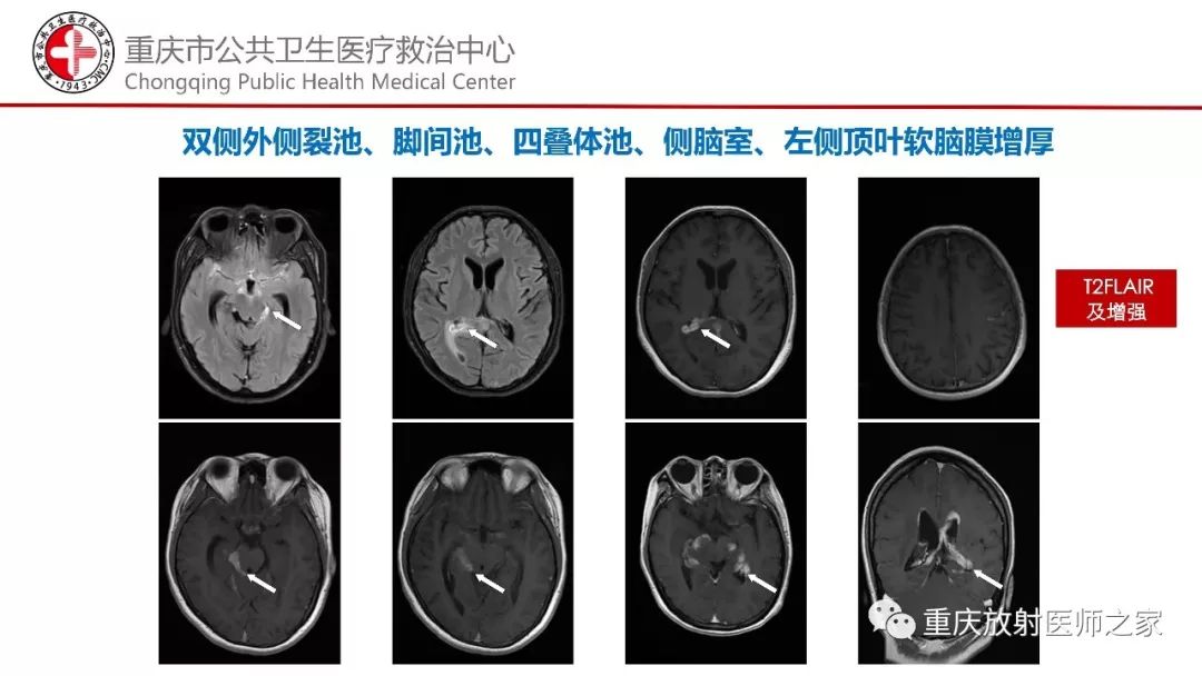 影像PPT - 【PPT】颅内结核分型及其影像学表现-14