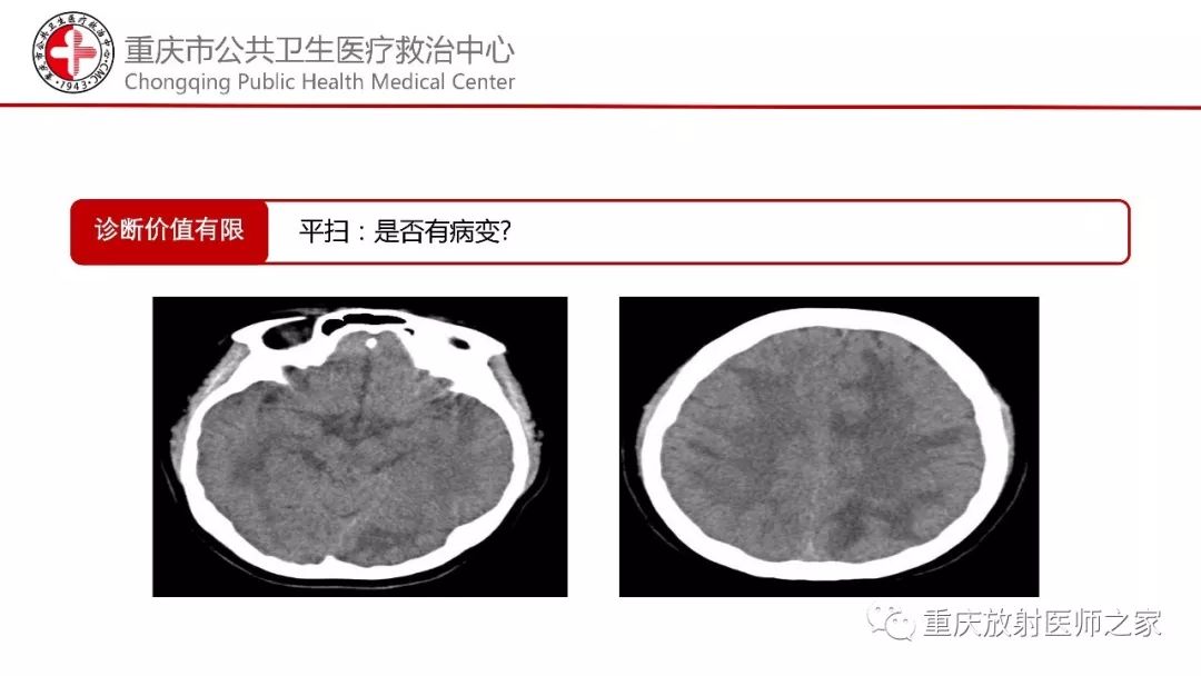 影像PPT - 【PPT】颅内结核分型及其影像学表现-16