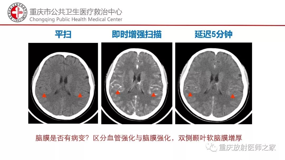 影像PPT - 【PPT】颅内结核分型及其影像学表现-17