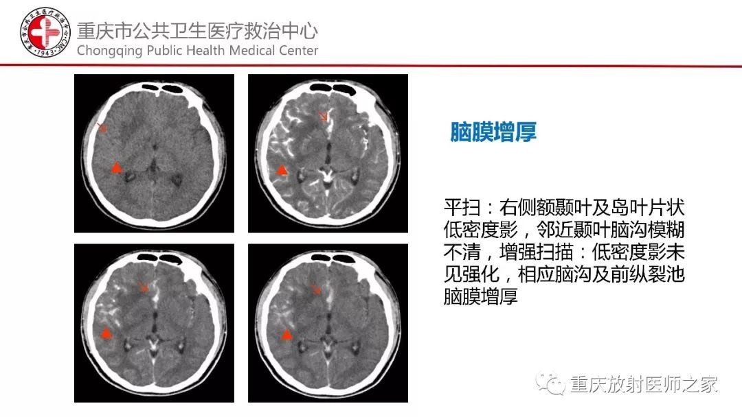 影像PPT - 【PPT】颅内结核分型及其影像学表现-18