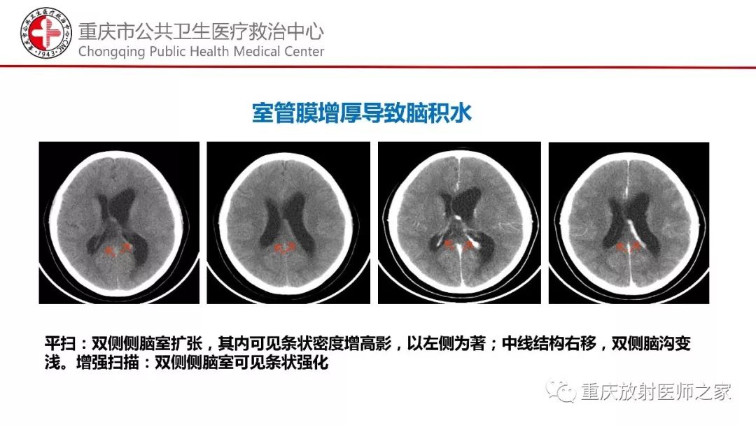 影像PPT - 【PPT】颅内结核分型及其影像学表现-19