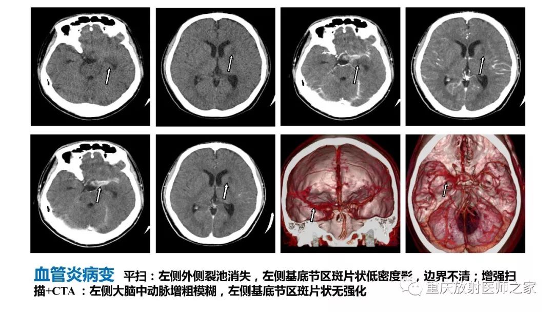 影像PPT - 【PPT】颅内结核分型及其影像学表现-20