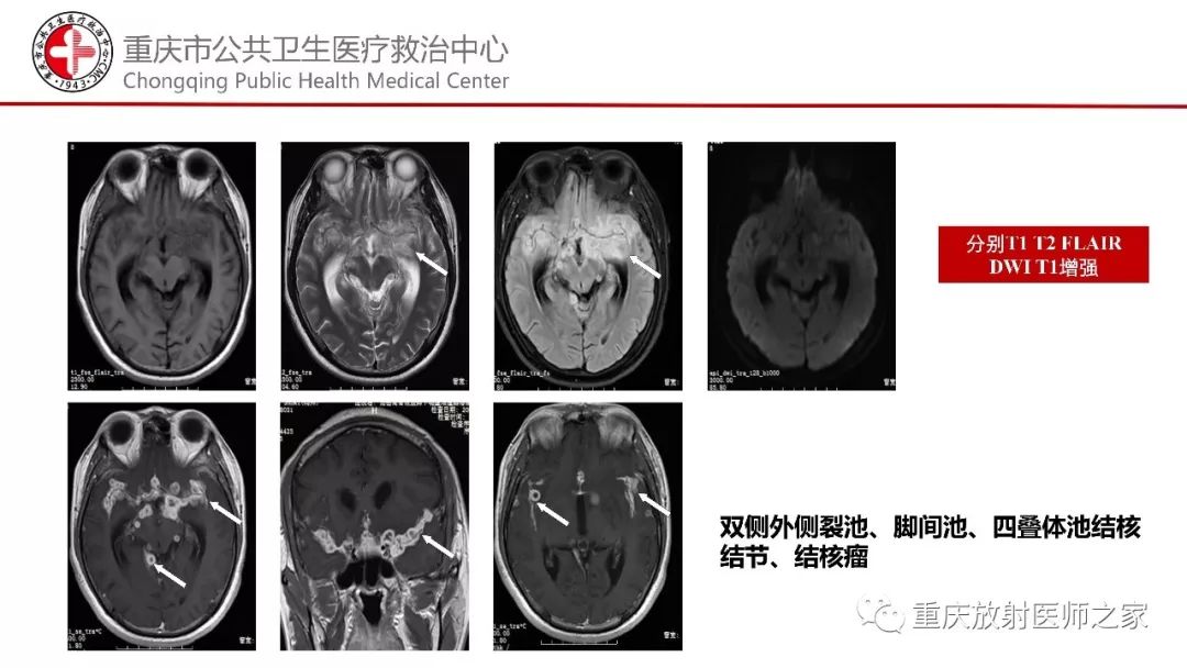 影像PPT - 【PPT】颅内结核分型及其影像学表现-22