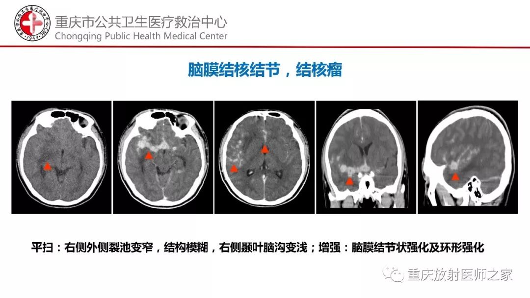 影像PPT - 【PPT】颅内结核分型及其影像学表现-24