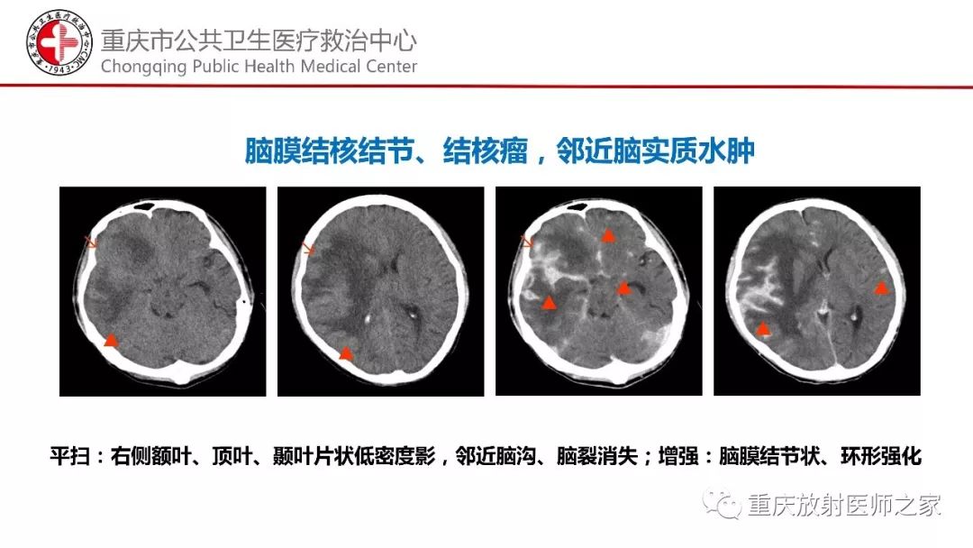 影像PPT - 【PPT】颅内结核分型及其影像学表现-25