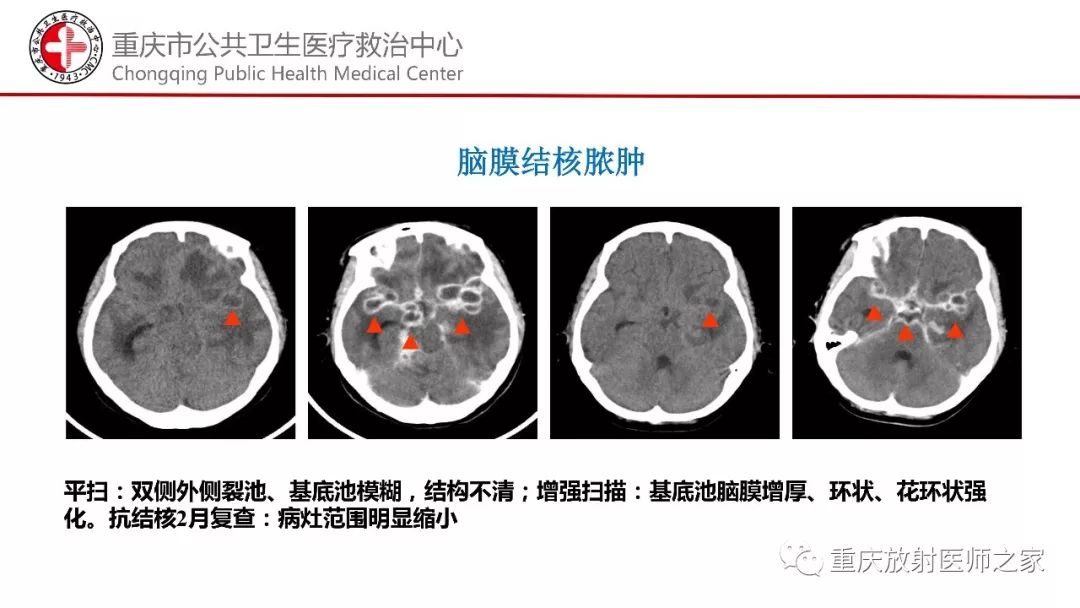 影像PPT - 【PPT】颅内结核分型及其影像学表现-27