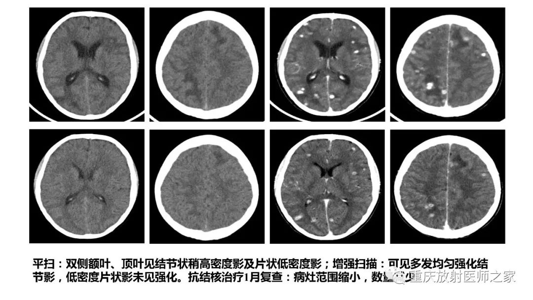 影像PPT - 【PPT】颅内结核分型及其影像学表现-31