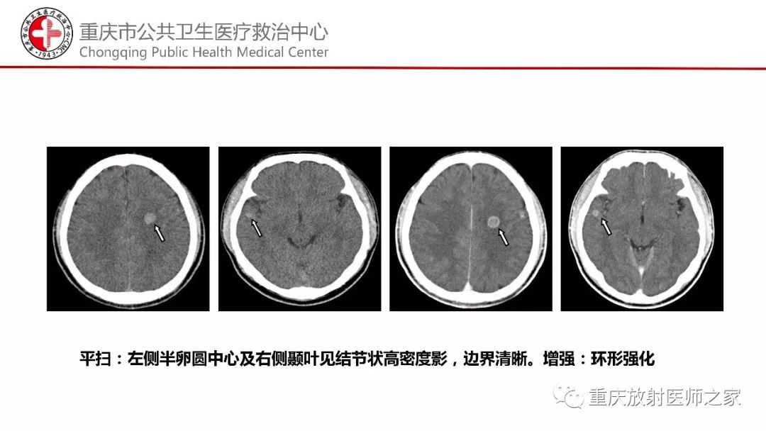 影像PPT - 【PPT】颅内结核分型及其影像学表现-32