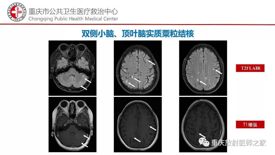 影像PPT - 【PPT】颅内结核分型及其影像学表现-30