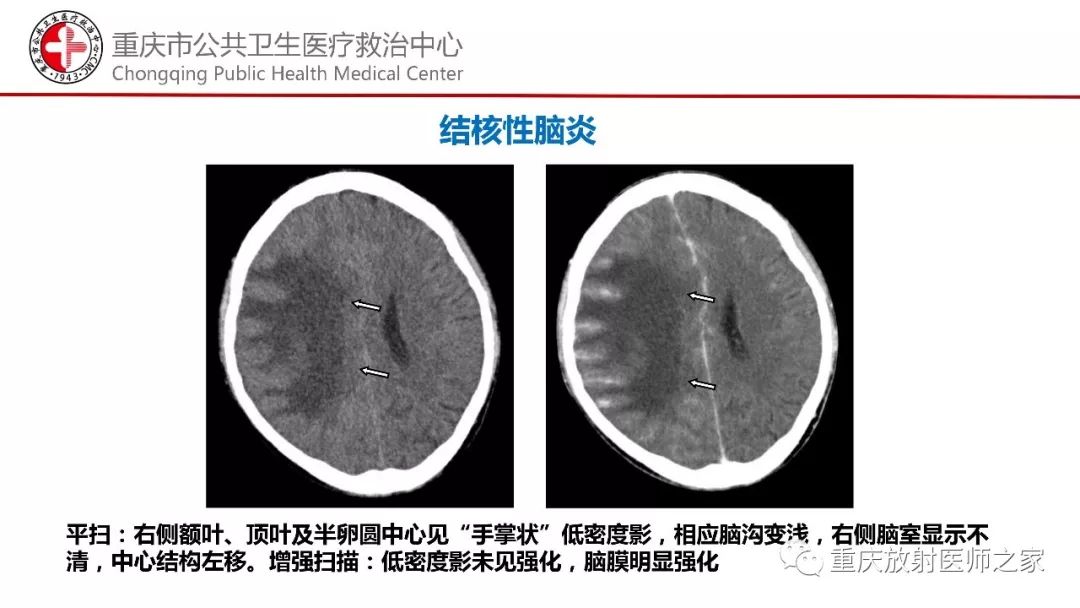 影像PPT - 【PPT】颅内结核分型及其影像学表现-34