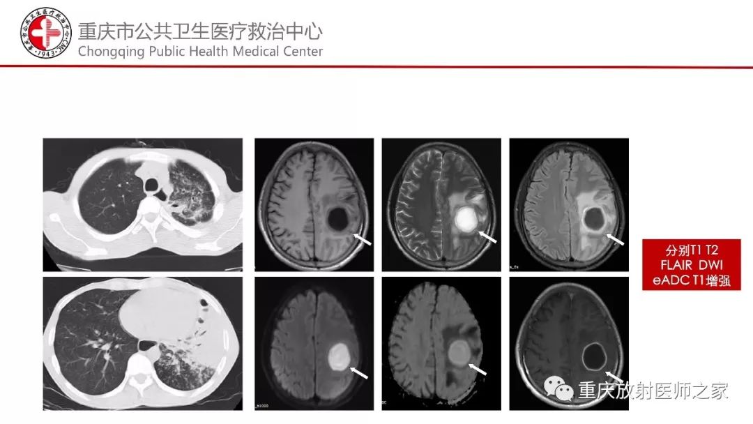 影像PPT - 【PPT】颅内结核分型及其影像学表现-36