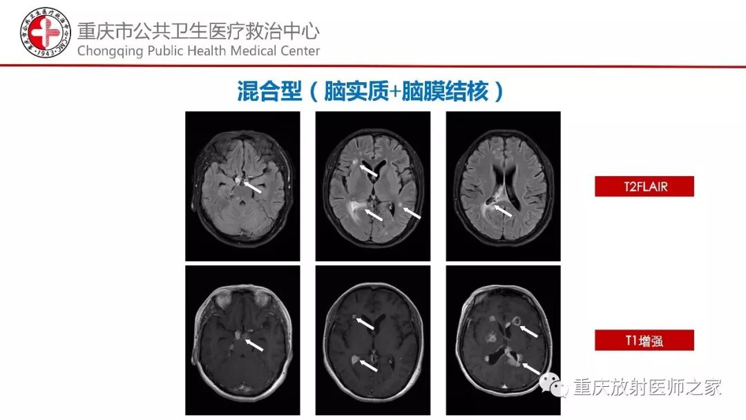 影像PPT - 【PPT】颅内结核分型及其影像学表现-39