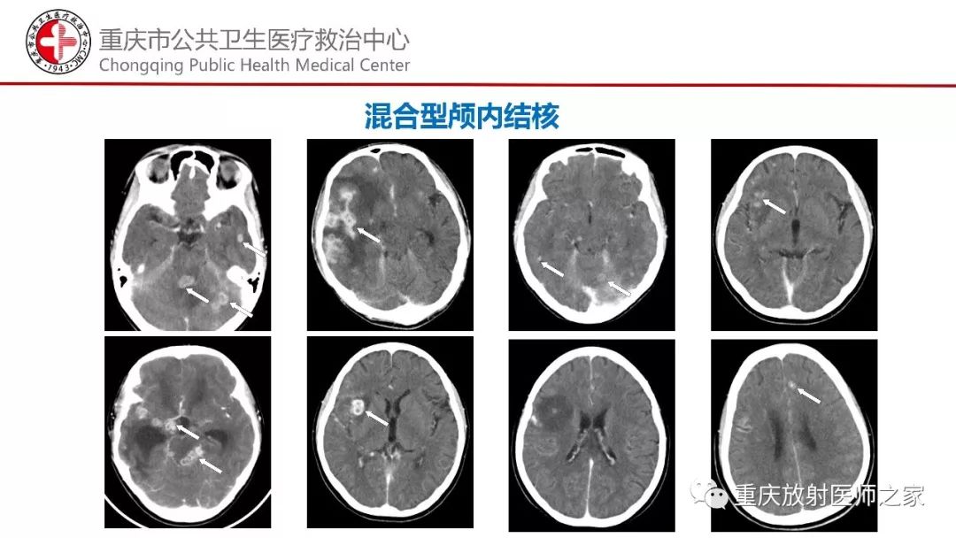 影像PPT - 【PPT】颅内结核分型及其影像学表现-40