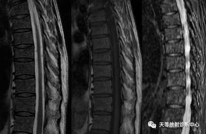 影像PPT - 浆细胞瘤-10 影像PPT - 浆细胞瘤-10