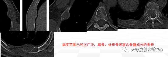 影像PPT - 浆细胞瘤-11 影像PPT - 浆细胞瘤-11
