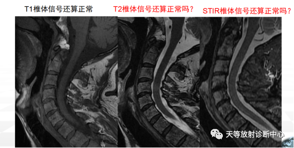 影像PPT - 浆细胞瘤-9 影像PPT - 浆细胞瘤-9