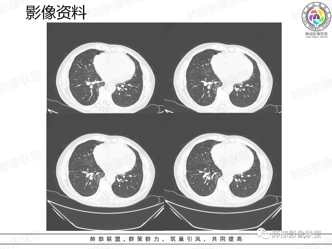 影像PPT - 【病例】一例囊腔性病变诊断思路与鉴别要点-4 影像PPT - 【病例】一例囊腔性病变诊断思路与鉴别要点-4