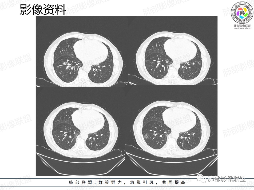 影像PPT - 【病例】一例囊腔性病变诊断思路与鉴别要点-5 影像PPT - 【病例】一例囊腔性病变诊断思路与鉴别要点-5