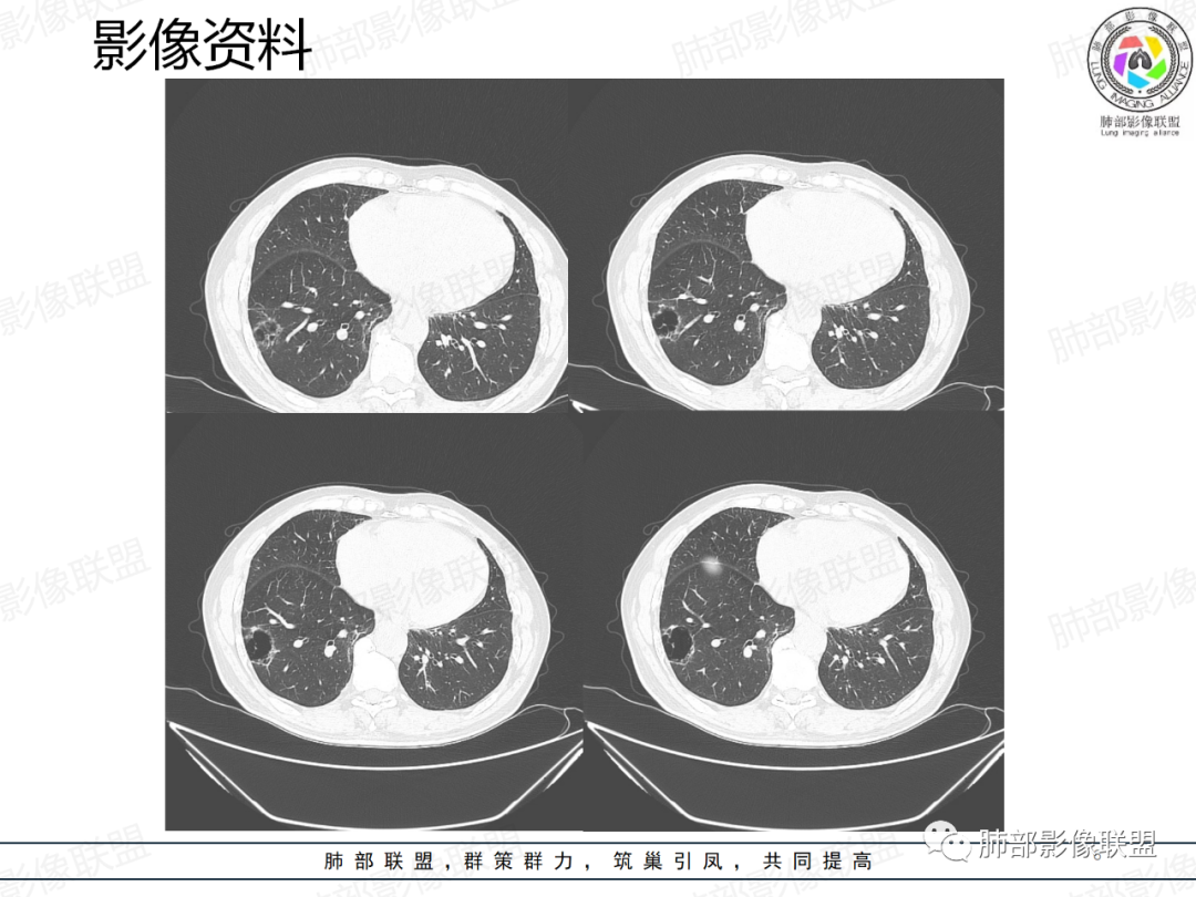 影像PPT - 【病例】一例囊腔性病变诊断思路与鉴别要点-6 影像PPT - 【病例】一例囊腔性病变诊断思路与鉴别要点-6