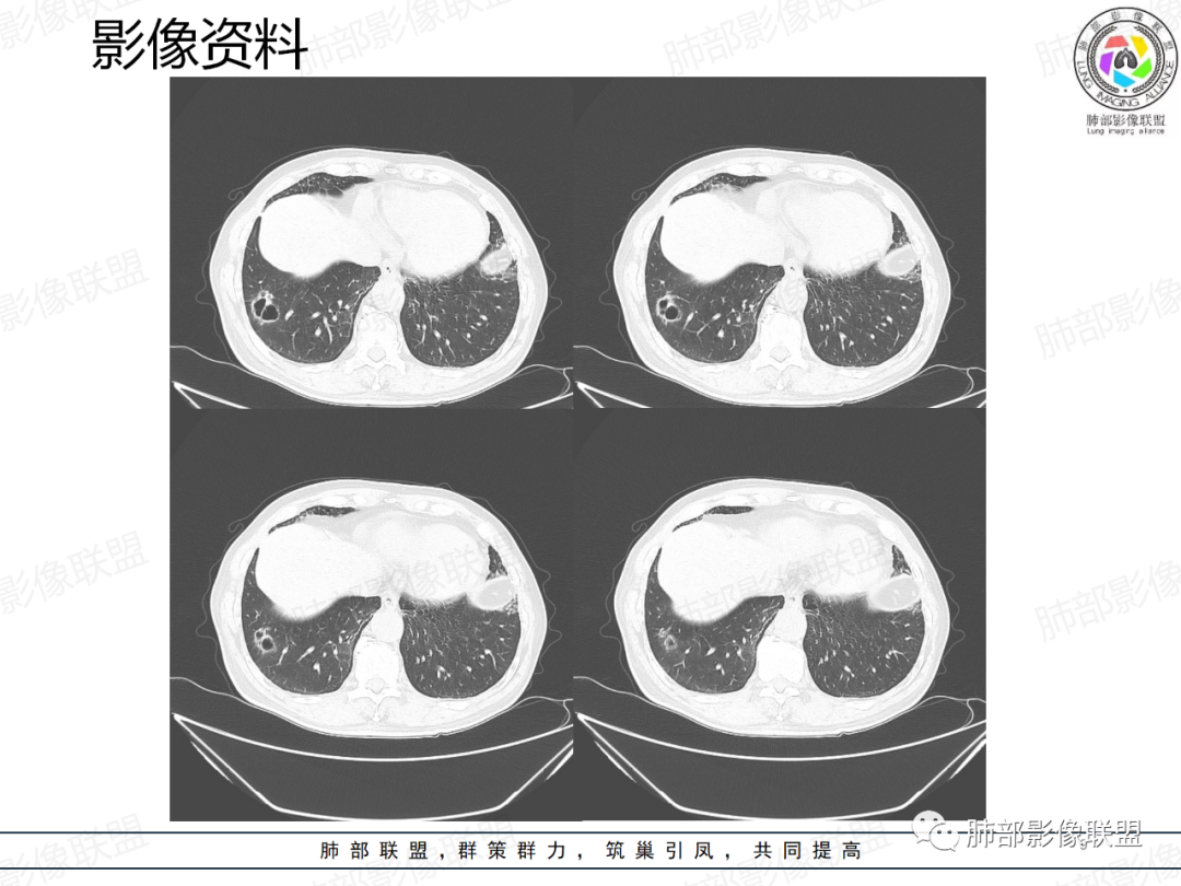 影像PPT - 【病例】一例囊腔性病变诊断思路与鉴别要点-9 影像PPT - 【病例】一例囊腔性病变诊断思路与鉴别要点-9