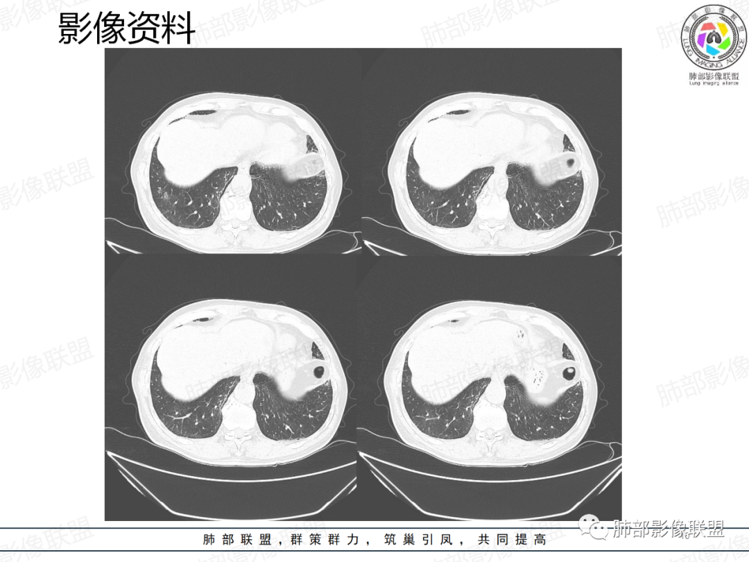影像PPT - 【病例】一例囊腔性病变诊断思路与鉴别要点-10 影像PPT - 【病例】一例囊腔性病变诊断思路与鉴别要点-10