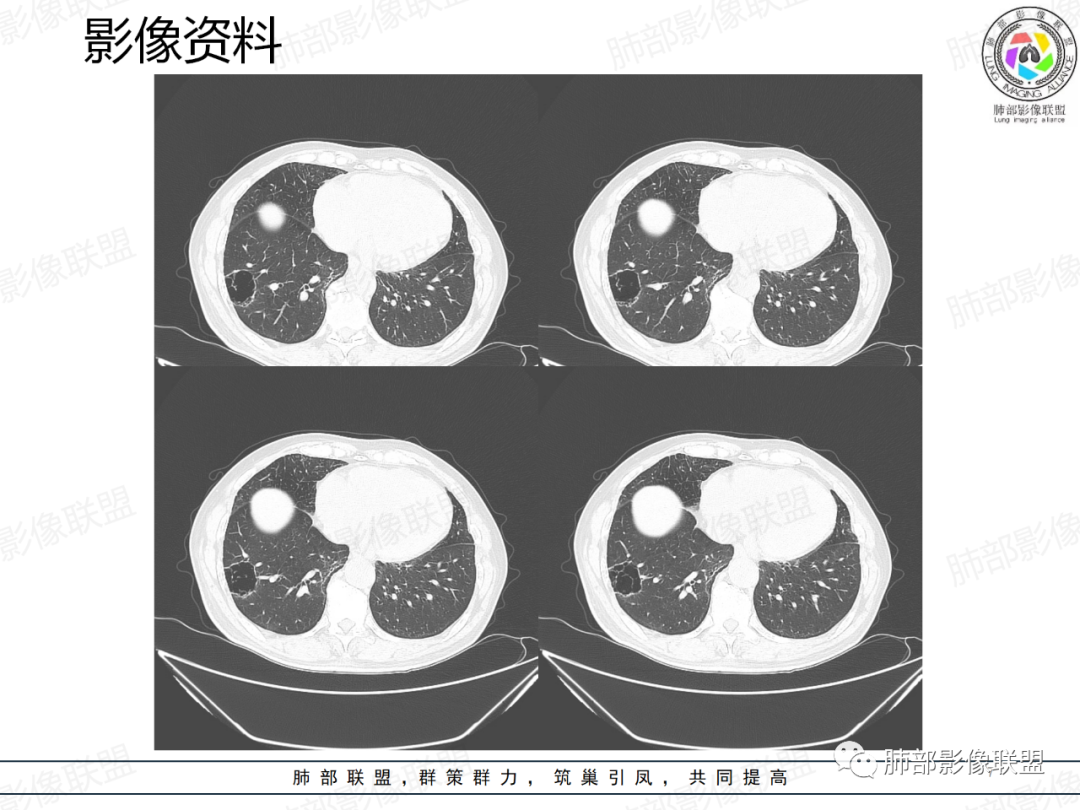 影像PPT - 【病例】一例囊腔性病变诊断思路与鉴别要点-7 影像PPT - 【病例】一例囊腔性病变诊断思路与鉴别要点-7
