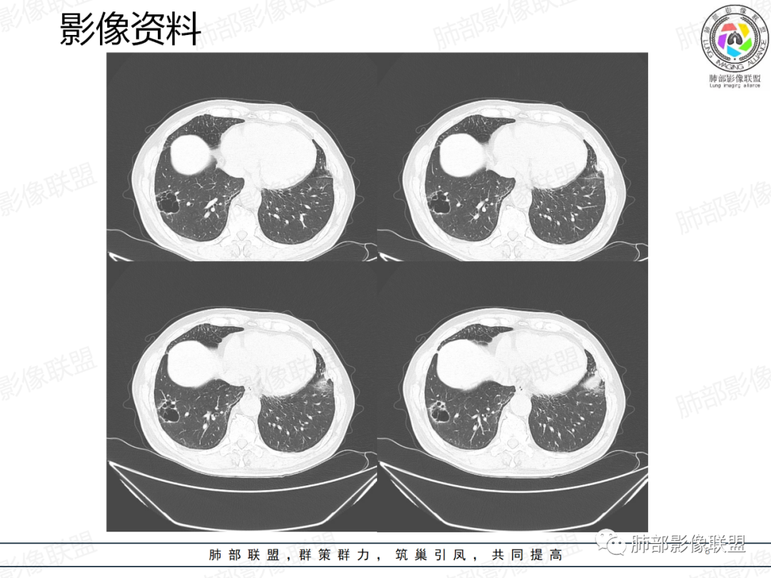 影像PPT - 【病例】一例囊腔性病变诊断思路与鉴别要点-8 影像PPT - 【病例】一例囊腔性病变诊断思路与鉴别要点-8