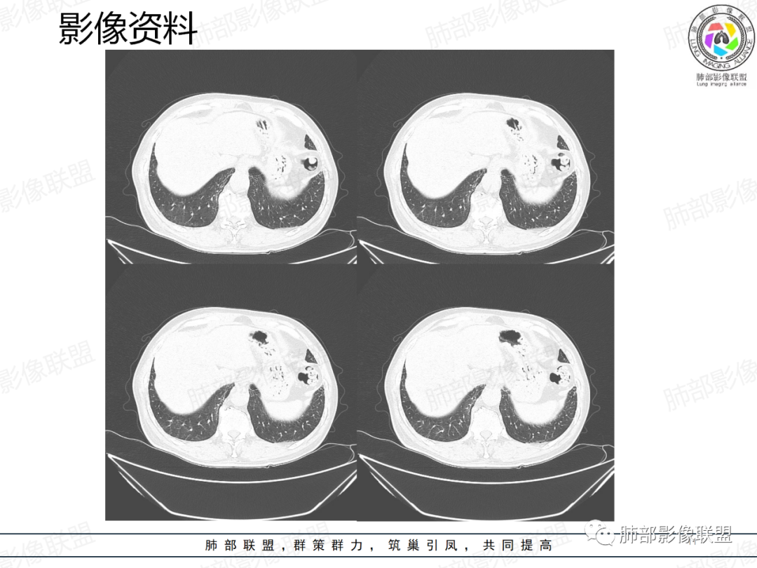 影像PPT - 【病例】一例囊腔性病变诊断思路与鉴别要点-11 影像PPT - 【病例】一例囊腔性病变诊断思路与鉴别要点-11